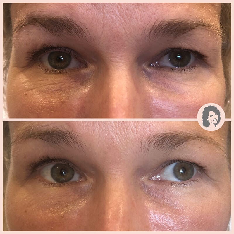 before after prf 800 copy