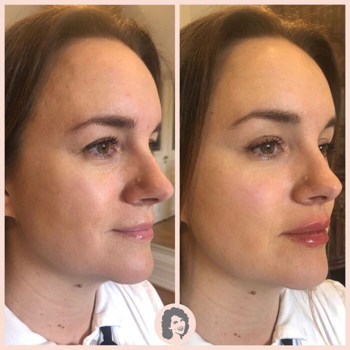Fillers ansikte fore efter