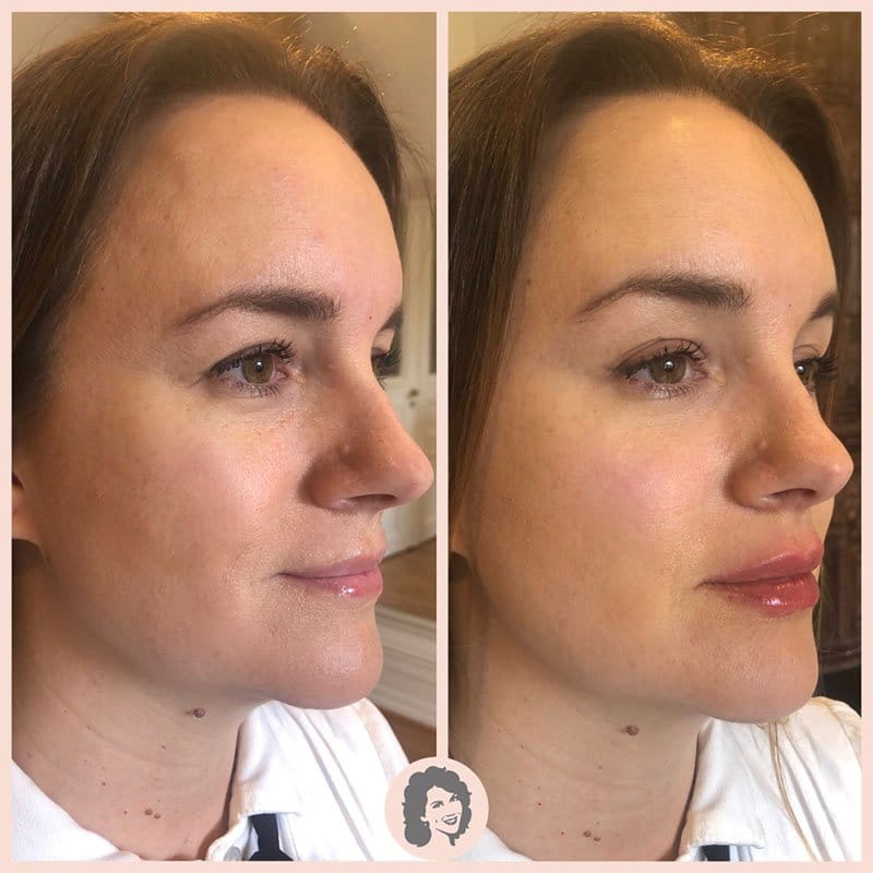 Fillers ansikte fore efter