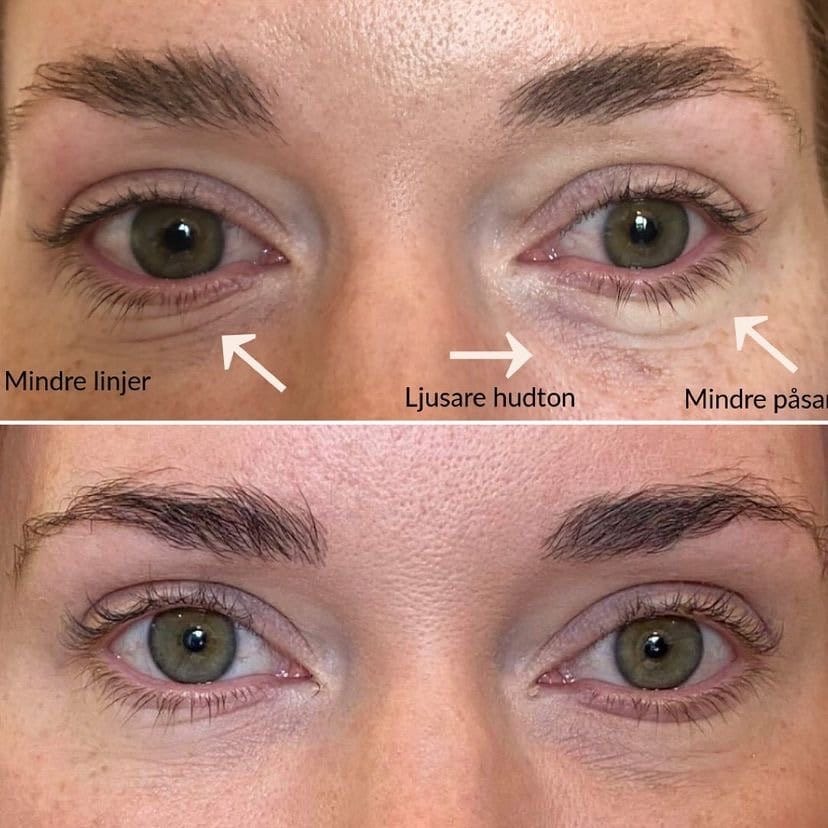 fore och efter sunekos