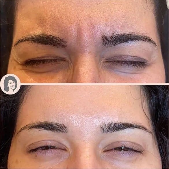 botox gothenburg