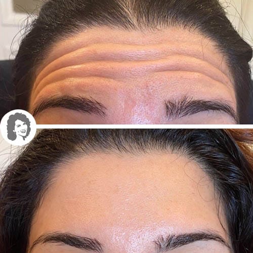 Botox frente