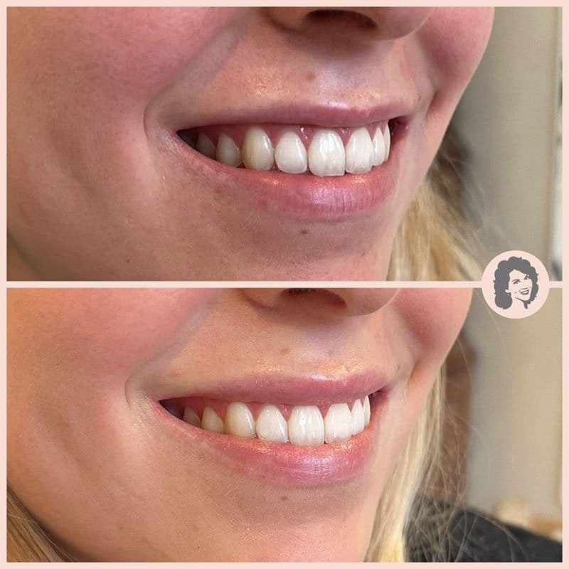 before after lip flip