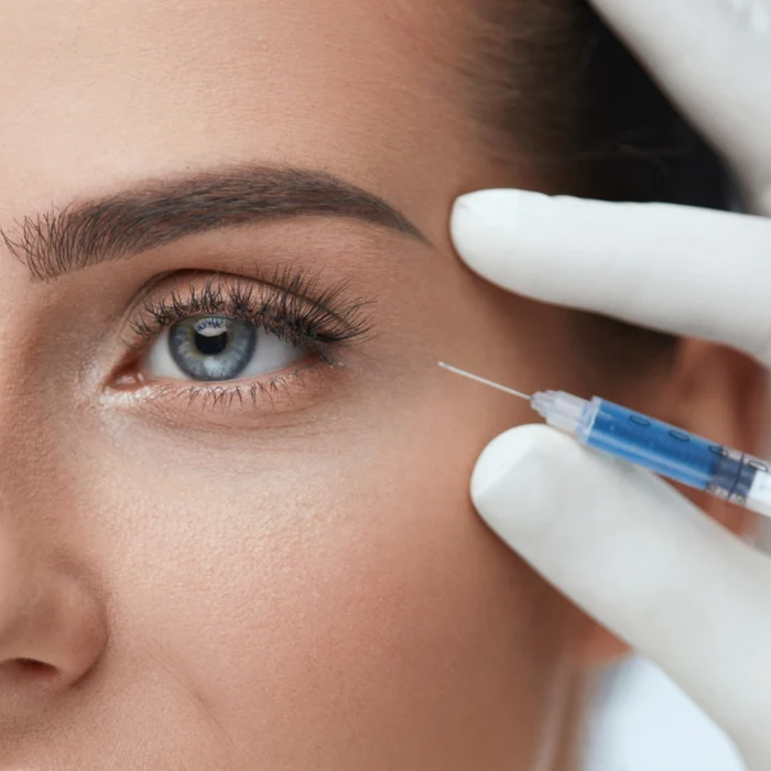 Fillers in the temples