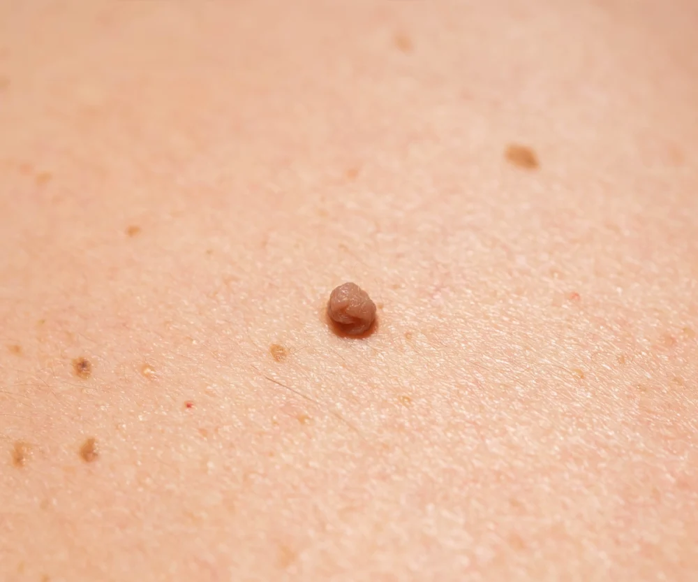 Skin tags