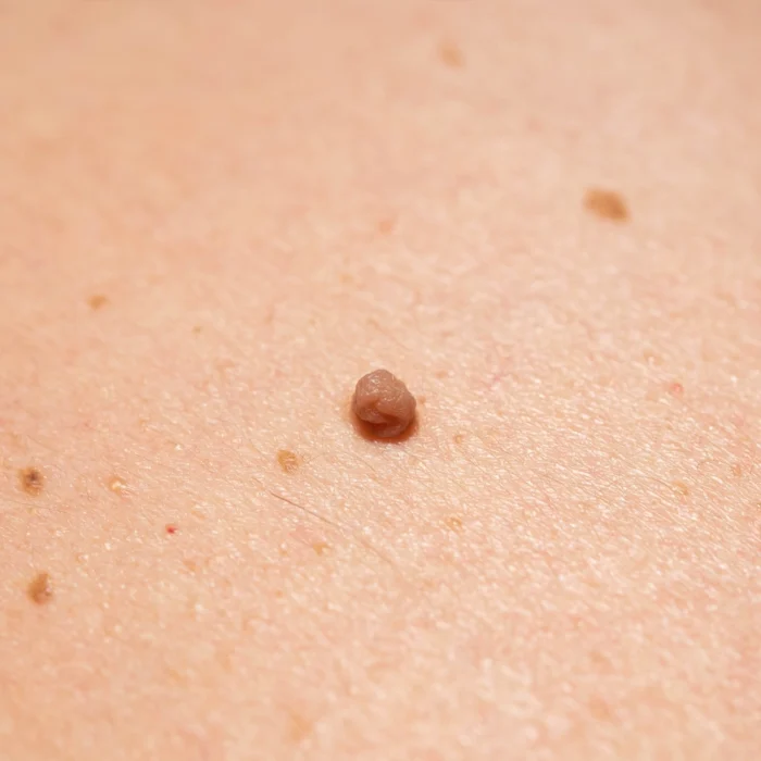 Skin tags
