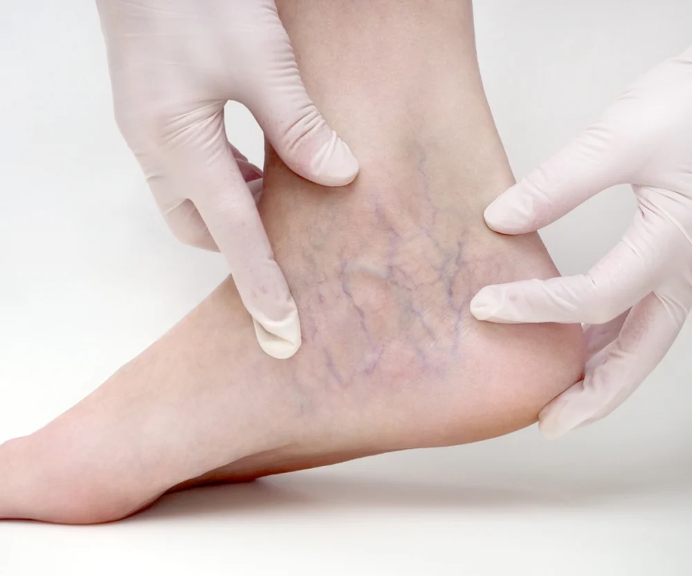 Escleroterapia