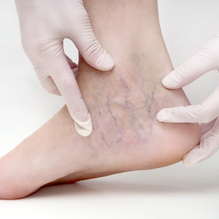 Escleroterapia
